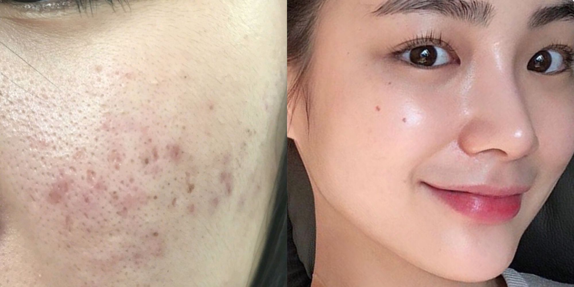 cara menghilangkan parut jerawat dalam masa seminggu
