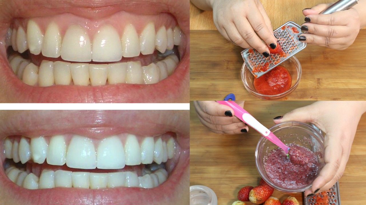 baking powder and strawberries to whiten teeth