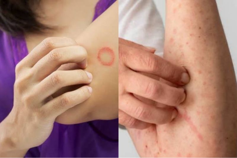 Penyebab Kudis Ilustrasi detail tungau Sarcoptes scabiei di permukaan kulit manusia, menyoroti proses infeksi yang menyebabkan kudis Mengenal Penyakit Kudis, Kutu atau Tungau Kecil yang Menyebabkan Gatal pada Kulit : Okezone health