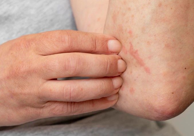 Ringworm Symptoms In Dogs Early Signs You Shouldnt Miss - jz64bb7