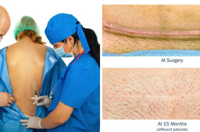 Berapa Kali Ibu Bisa Melahirkan Sesar, Ternyata Tidak