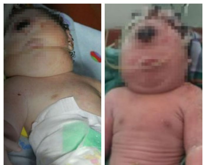 Bayi lahir tanpa mata dan hidung