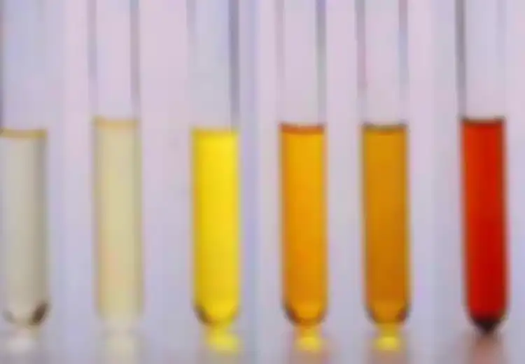 Perhatikan Perubahan Warna dan Bau pada Urine yang Perlu Diwaspadai, Salah Satunya Bisa Jadi Tanda Adanya Batu Ginjal