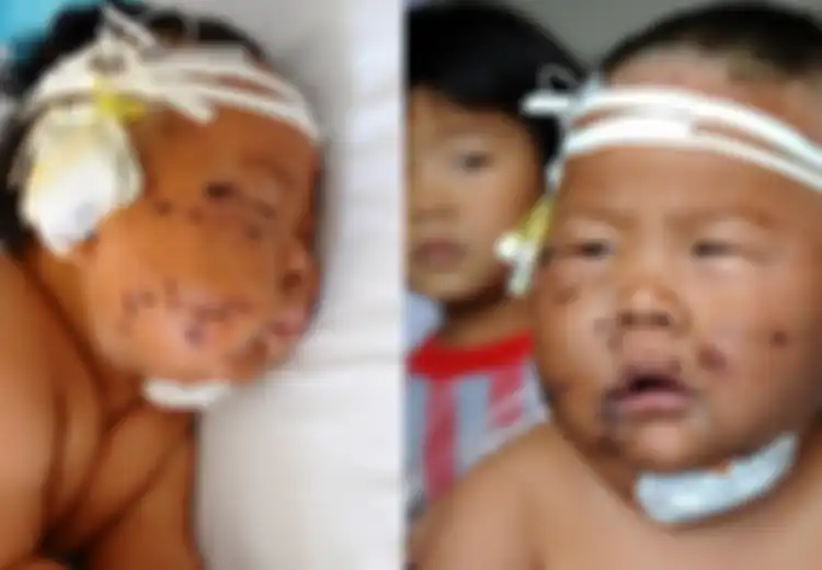 Kasian, Bayi 8 Bulan Ditusuk 90 Kali dengan Gunting Gara-gara Gigit Puting Ibunya Saat Menyusu