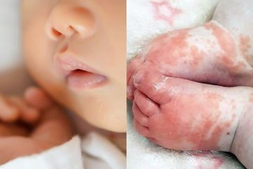 Bayi usia 8 bulan ini meninggal karena kondisi Covid-19 langka.