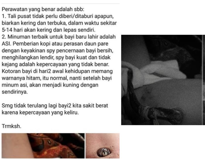 Salah rawat tali pusat, bayi alami sakit serius