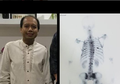 Sutopo Purwo Alami Skoliosis Akibat Kanker Paru yang Dialaminya, Begini Penjelasannya