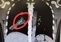 Perempuan Asal China Batuk Terus Menerus, Diagnosa Bronchiektasis Dokter Salah, Saat Dioperasi Ditemukan Tulang Ayam di Paru-parunya