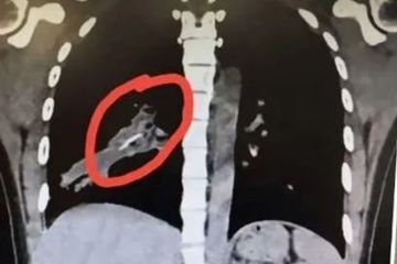 Perempuan Asal China Batuk Terus Menerus, Diagnosa Bronchiektasis Dokter Salah, Saat Dioperasi Ditemukan Tulang Ayam di Paru-parunya 
