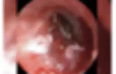Dengar Suara Berdengung di Telinga, Ternyata Ada Hewan Kecil Ini di Telinga Bocah Laki-laki Ini