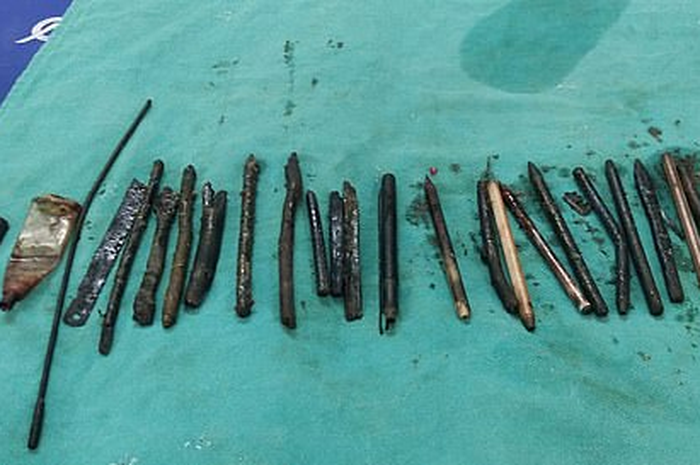 Seorang dokter diketahui telah mengangkat 33 benda dari perut seorang pria India, termasuk pisau cukur.