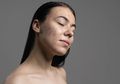 Pilihan Perawatan Wajah Bopeng Acne Scar di Klinik Kecantikan dengan Biostimulator Filler dan Picolaser Serta Chemical Peeling