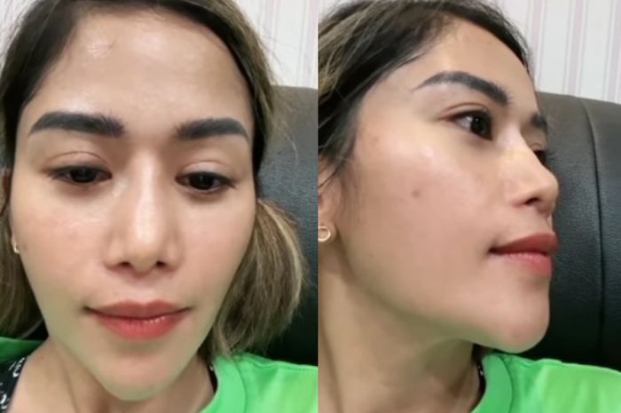 Farida Nurhan pamer hasil oplas hidung tiga kali