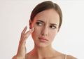 Perbedaan Whitehead, Milia dan Fungal Acne serta Cara Mengatasinya
