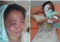 Kejam, Suami Asal Sulawesi Ini Setrika Wajah Istrinya Karena Salah Paham!