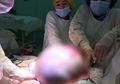 Dokter Bedah Berhasil Angkat Tumor Seukuran Bola Pantai yang Beratnya 25 Kg dari Ovarium, yang Bikin Wanita Ini Sulit Bernapas