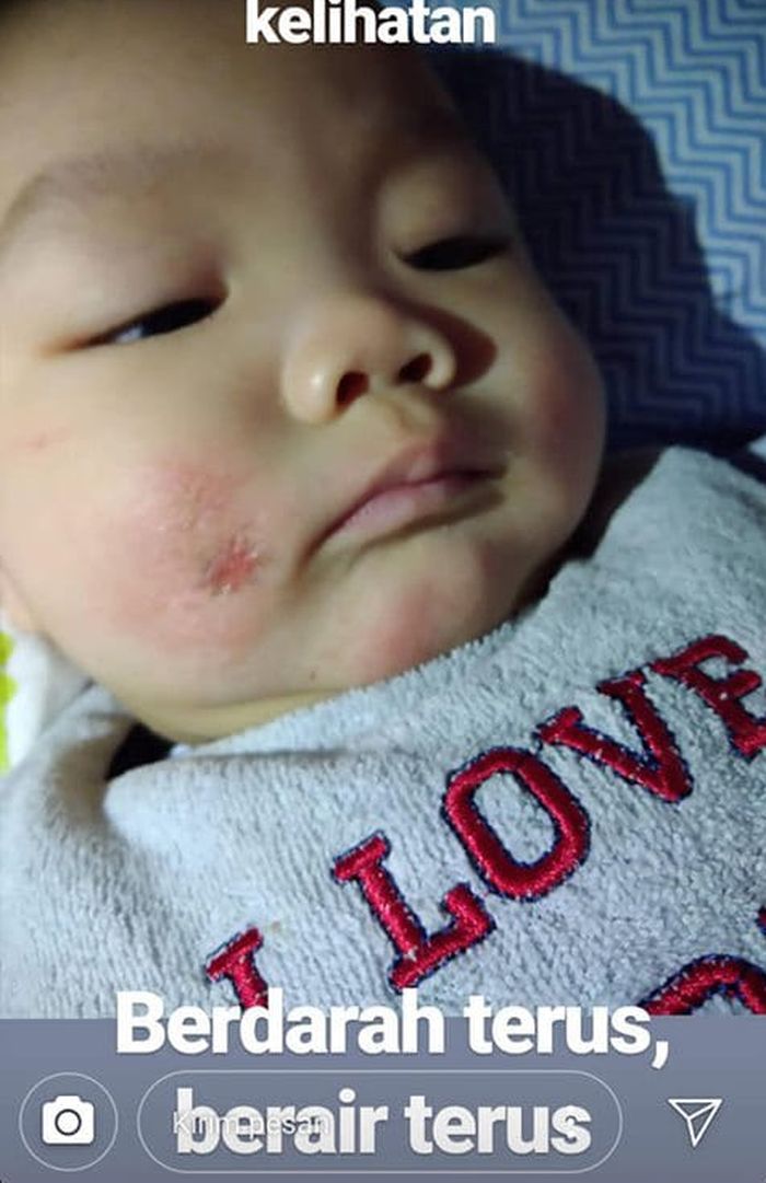 Ryu terkena dermatitis atopik