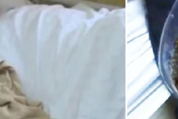Batu empedu dari seorang pasien perempuan.