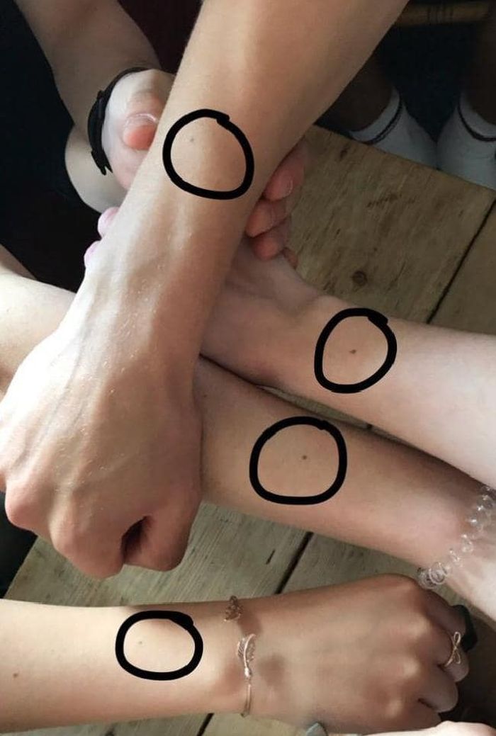 Anda Punya Tahi Lalat Kembar Yang Simetris Ketahuilah Faktor Penyebabnya Berikut Semua Halaman Intisari