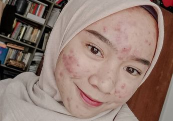 Viral Karena Tetap Pede Meski Jerawatan Parah, Yuk Belajar dari Sosok Novia Nur Ismi. Inspiratif Banget!