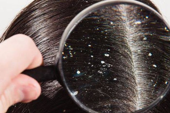 Kandungan Sampo Ampuh Menghilangkan Ketombe, Mudah Ditemukan! - Stylo