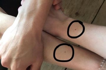 Anda Punya Tahi Lalat Kembar Yang Simetris Ketahuilah Faktor Penyebabnya Berikut Semua Halaman Intisari