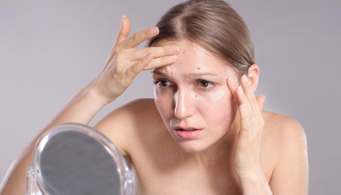 Jerawat muncul karena hormon, ketahui penyebab dan cara mengatasinya dengan tepat.