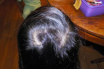 Pusaran Rambut Di Depan