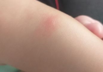 Rekomendasi Obat Alergi Kulit Bayi dari Bahan Rumahan hingga yang Tersedia di Apotek, Cek di Sini, Moms!