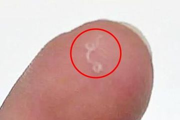 Gejala infeksi cacing gelang pada anak yang perlu diwaspadai.