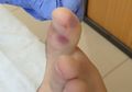 Tak hanya Demam atau Baruk-batuk, Ahli Medis Sebut Lesi Mirip Cacar Air pada Kaki Bisa Menjadi Gejala Baru Virus Corona