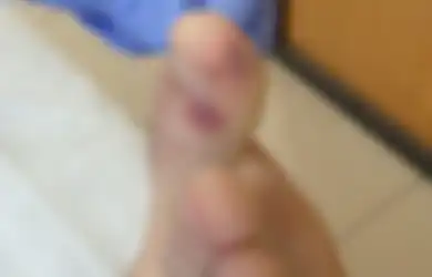 Tak hanya Demam atau Baruk-batuk, Ahli Medis Sebut Lesi Mirip Cacar Air pada Kaki Bisa Menjadi Gejala Baru Virus Corona