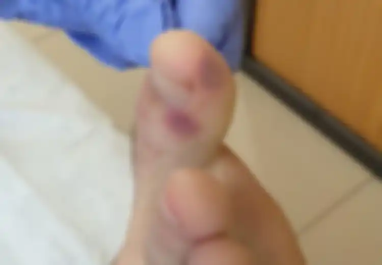 Tak hanya Demam atau Baruk-batuk, Ahli Medis Sebut Lesi Mirip Cacar Air pada Kaki Bisa Menjadi Gejala Baru Virus Corona