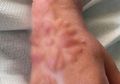 Hati-hati Pakai Henna Tangan, Tangan Wanita Ini Melepuh Setelah Memakainya