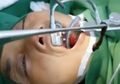 Dokter Berhasil Mengeluarkan Hewan Parasit yang Bersarang di Dalam Tubuh Manusia Selama 3 Bulan, Seperti Ini Wujudnya