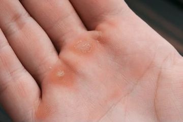 Beberapa rekomendasi obat kapalan di kaki dan tangan yang dipercaya aman.