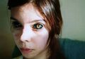 Seorang Model Wanita yang Masih Muda Mengalami Kebutaan setelah Lakukan Tato Bola Mata, Meski Sempat Menjadi Trend, Ternyata Ini Bahaya Tindakan Tato yang Satu Ini