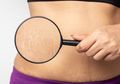 Cara Hilangkan Stretch Mark Pakai Bahan Alami yang Bisa Dilakukan Saat Puasa