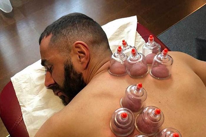 Pemain Real Madrid, Karim Benzema, melakukan terapi bekam.