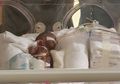 Tangannya saat Dipasangi Cincin Kejutkan Banyak Orang, Bayi Prematur Ini Benar-benar Lahir dengan Tubuh Sangat Kecil, Kurang dari Setengah Kilogram
