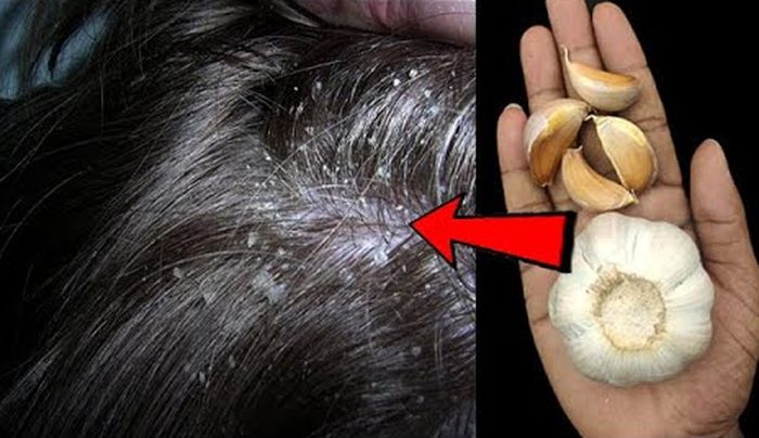 Bawang putih untuk hilangkan kutu rambut
