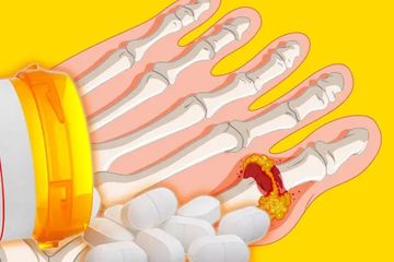 Inilah beberapa rekomendasi obat perontok asam urat yang ada di apotek.