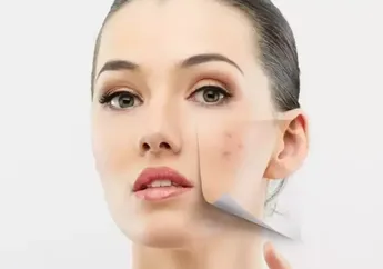 Skincare Aja Enggak Cukup, Gini 5 Cara Mengatasi Jerawat karena PCOS