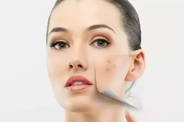 Ilustrasi bekas jerawat pudar dengan serum lokal di bawah 30 ribu