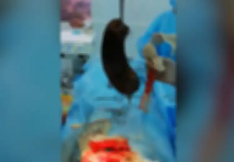 Sakit Perut, Remaja Ini Ternyata 'Mengandung' Rambut Seberat 3,65 Kg