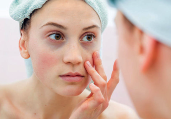 Bisa Hilangkan Jerawat, 3 Kandungan Skincare Ini Malah Bikin Kulit Iritasi