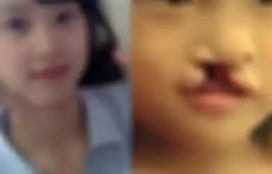Li Lan gadis cantik yang dibuang orangtuanya karena cacat sumbing