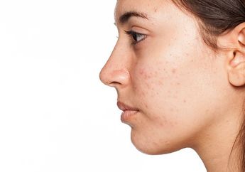 The Best! 3 Serum Vitamin C Ini Ampuh Hilangkan Bekas Jerawat Bandel!