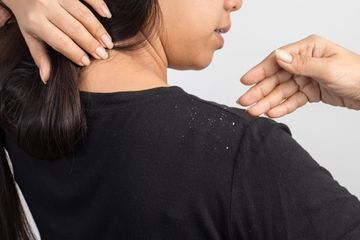 Menghilangkan ketombe di kulit kepala dengan air garam