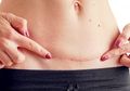 Moms yang Baru Bersalin Wajib Tahu, Inilah Cara Merawat Luka Jahitan Usai Melahirkan Sesar Agar Tak Infeksi
